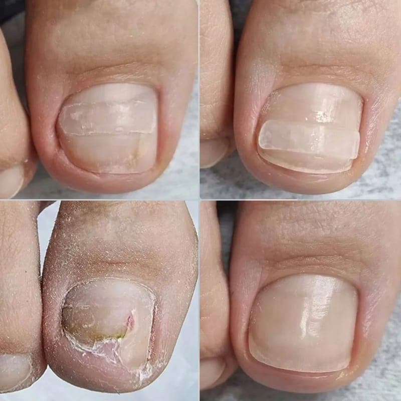 Before and after on a toenail: damaged and flaking in the left frames, smooth and even in the right ones