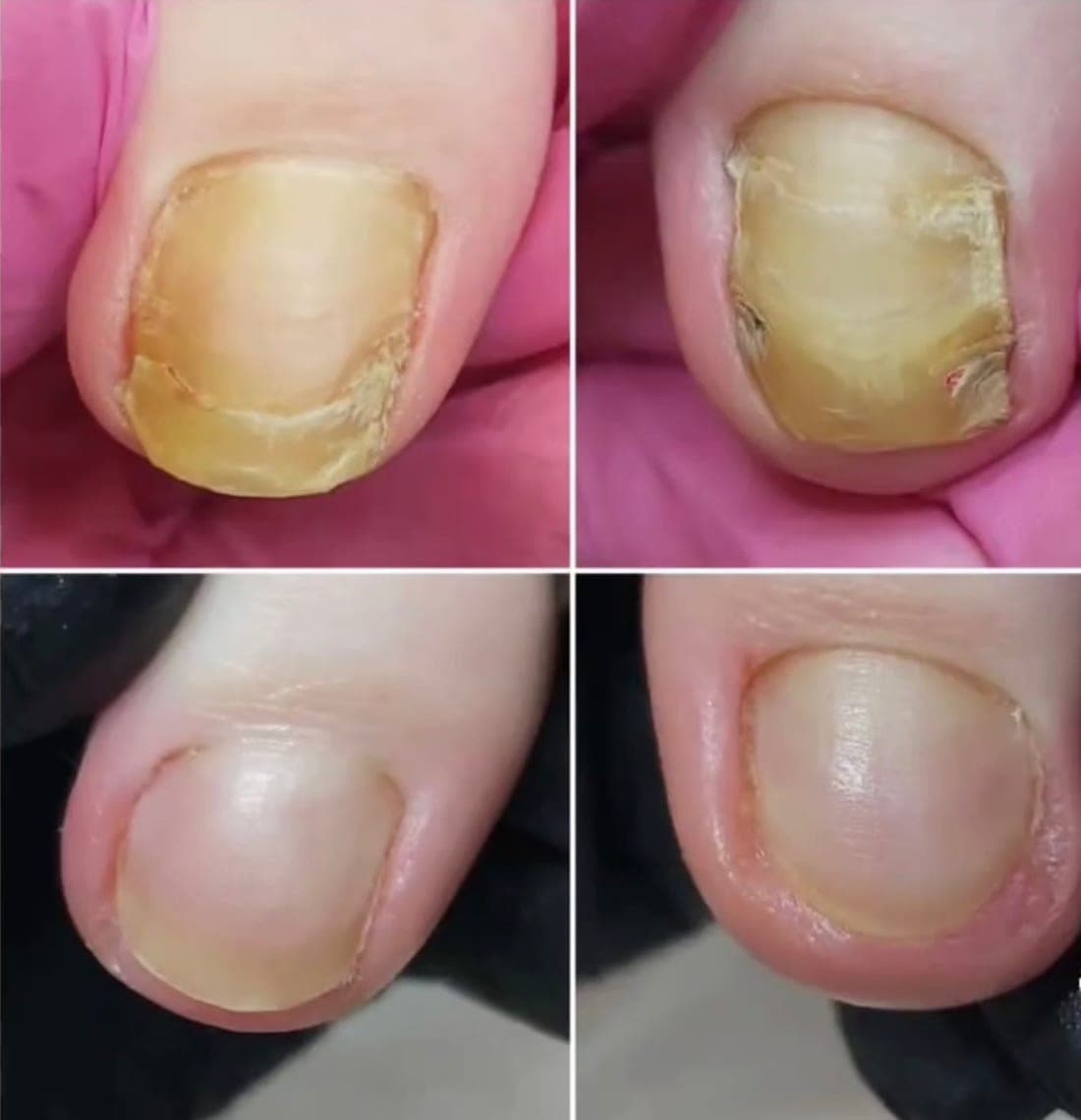Two thick, yellowed toenails above, and the same nails cleaned and smoothed below
