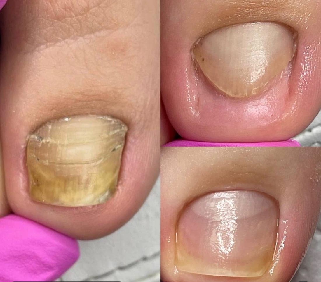 A thick, yellowed toenail on the left, and the same nail cleaned and thinned on the right