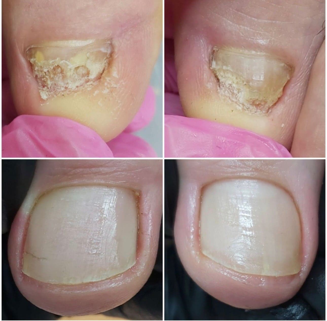 Two rough, yellowed toenails above, and the same nails cleaned and smooth below